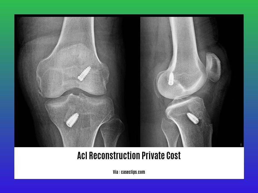  ACL Reconstruction Private Costs An InDepth Analysis Wave Sold