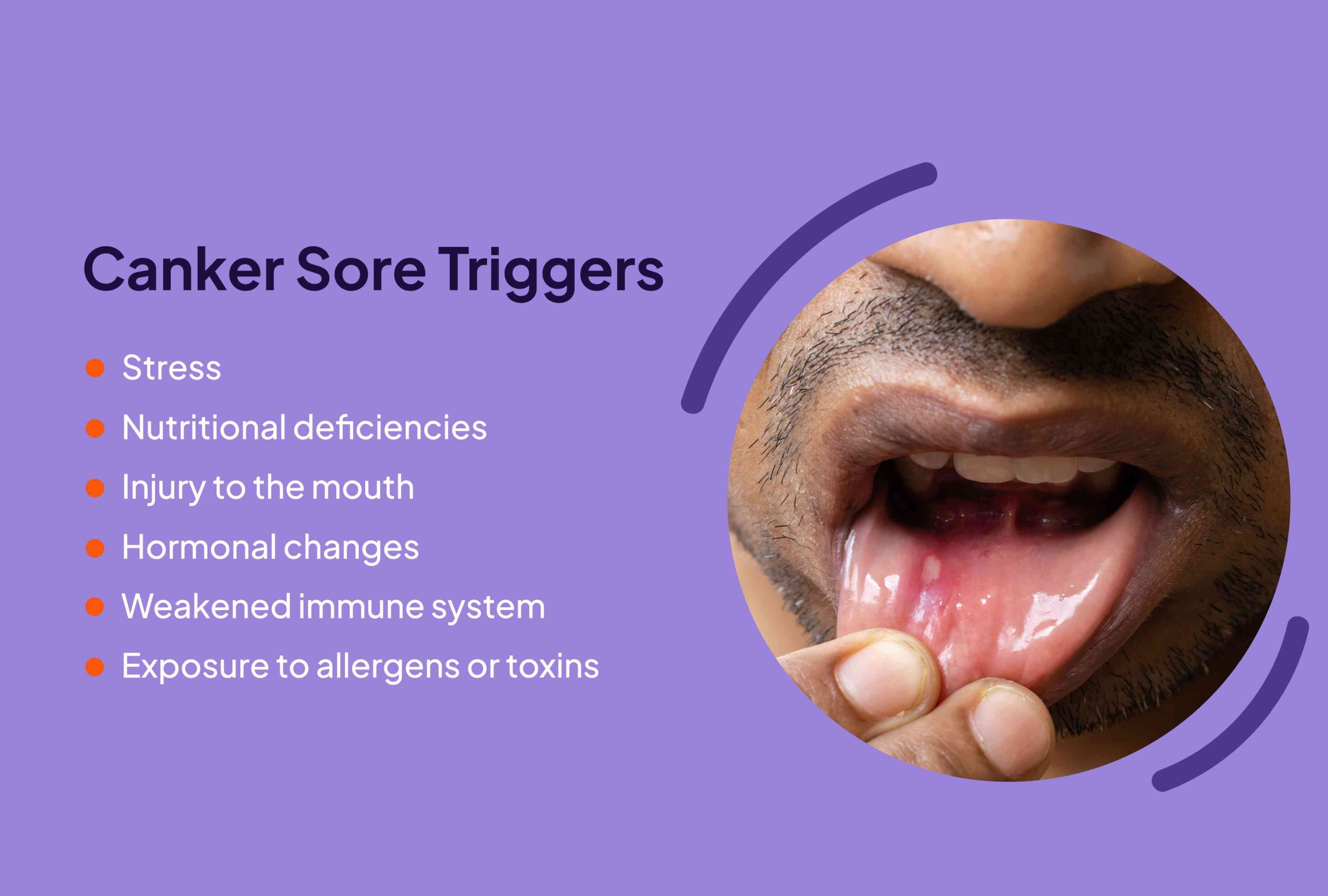 best home remedy for canker sore on tongue