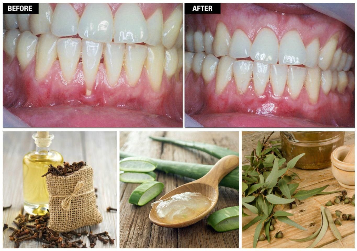 home remedies for gum infection