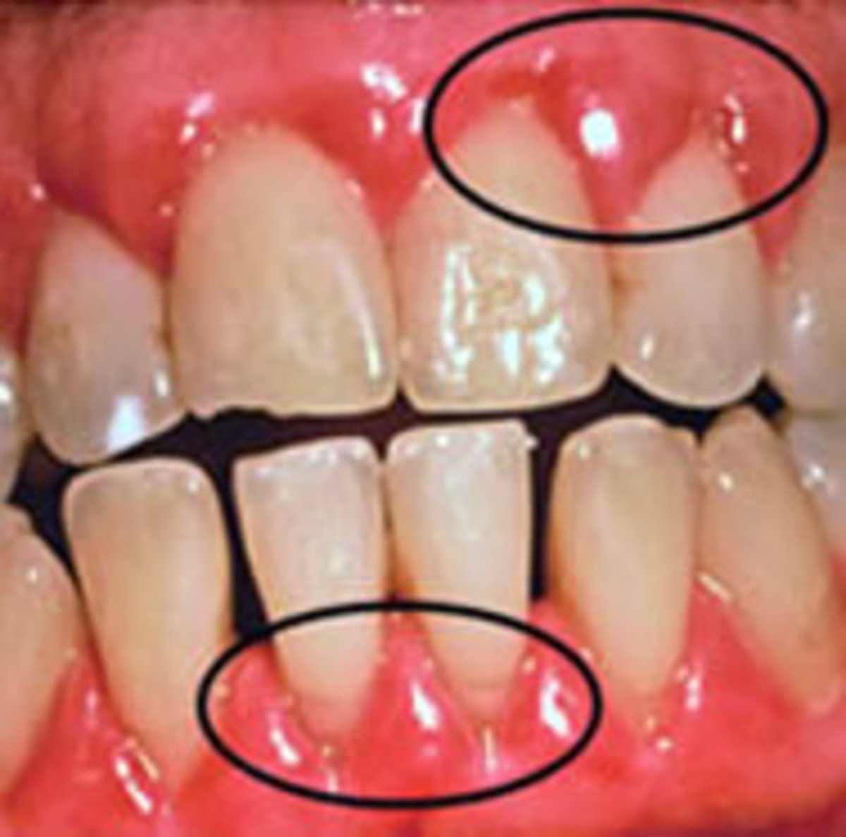 home remedies for gum irritation