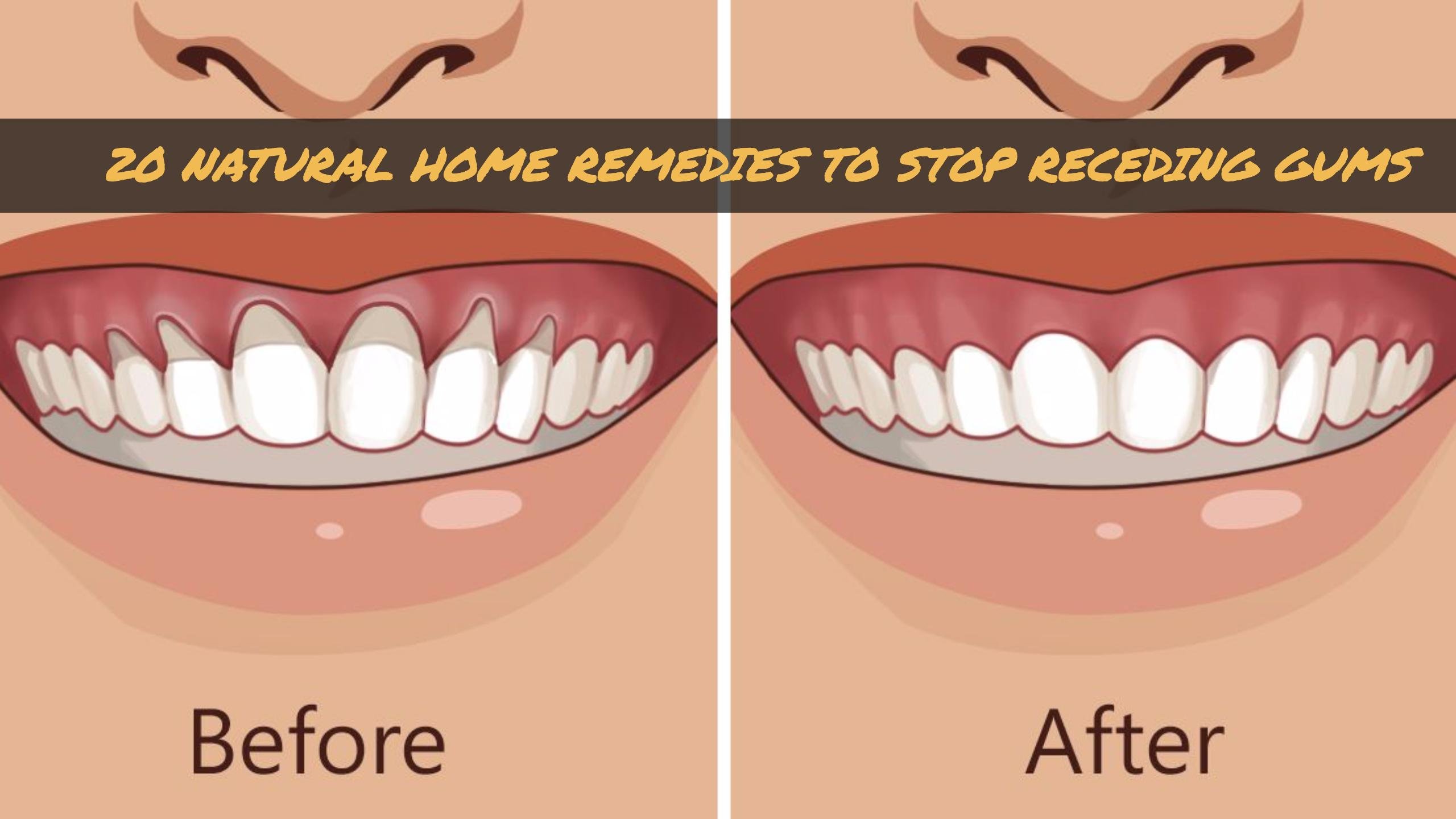home remedies for gum sores