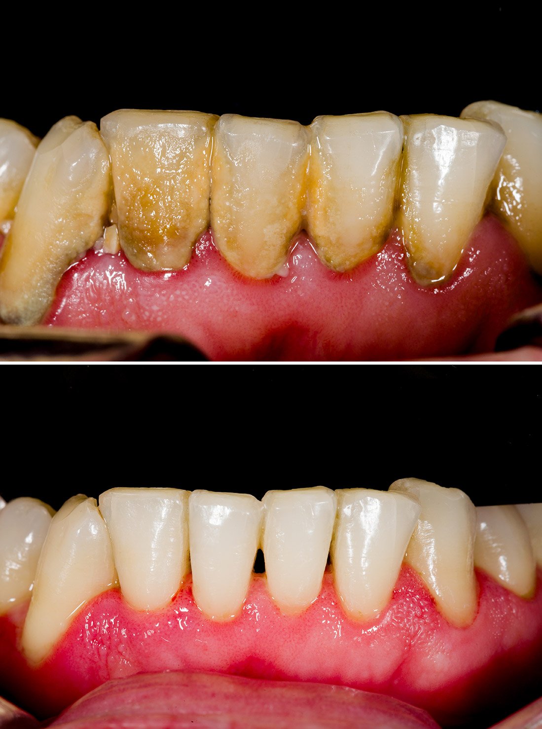 home remedies for periodontal disease