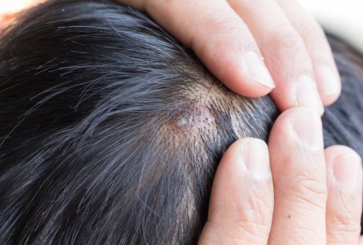 home remedies for scalp sores