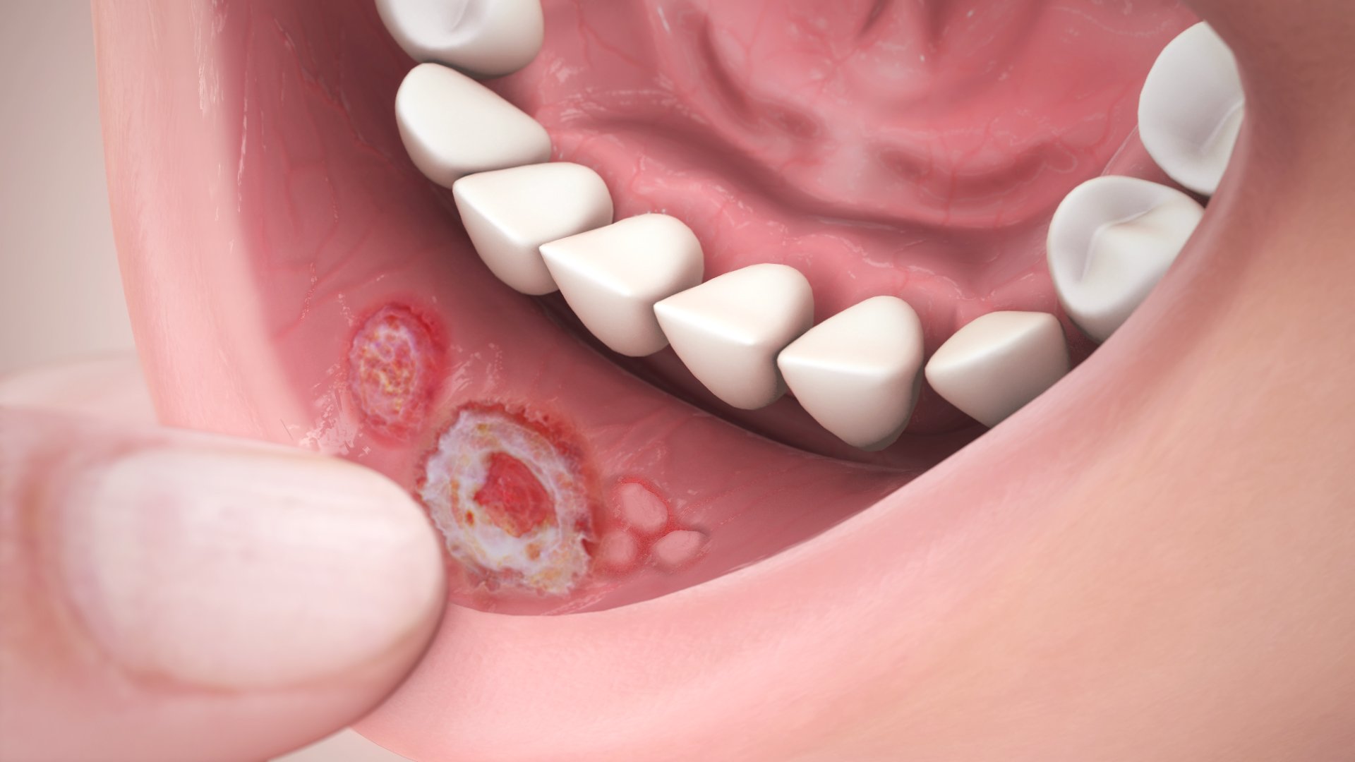 home remedies for sores inside mouth